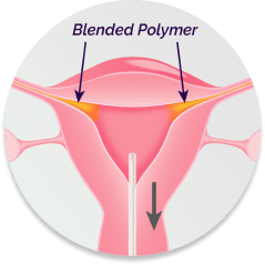 FemBloc Step 4