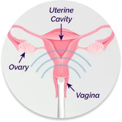 FemChec Step 1