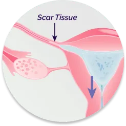 FemChec Step 4