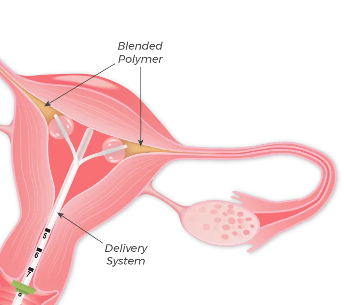 FemBloc Handheld Device
